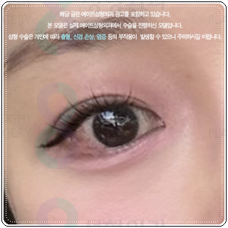 세미아웃라인 쌍수를 매몰로 하는법? 발품 비용 상담 후기 참고용 관련 이미지 3