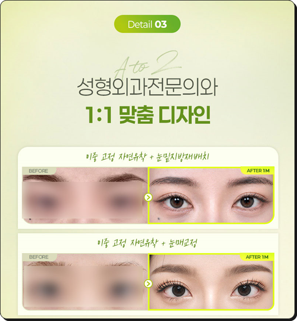 쌍꺼풀수술은 꼭 비절개가 좋을까? 부분절개와 절개의 비용 대비 효과는? 관련 이미지 9