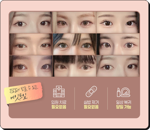 앞트임을 고민할 때, 눈매에 따라 달라지는 선택 관련 이미지 7
