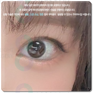 자연유착쌍커플 후기, 쌍수 할 때 재수술 없이 성공하려면? (비용 문의) 관련 이미지 5