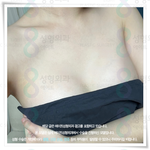 가슴성형 시 사용되는 보형물 종류와 가격 차이는 왜 생기나요? 관련 이미지 4