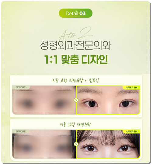 Why Choose Partial Incision Instead of Non-Incision Double-Eyelid Surgery? Meaning, Cost, and When Does the Swelling Go Down? image 13