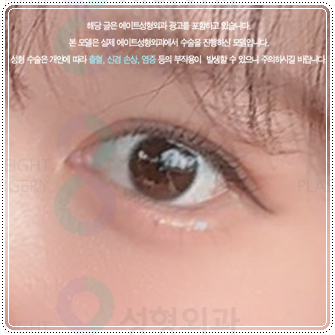 Preparing for the Cost and Swelling When Combining Medial and Lateral Canthoplasty with Double-Eyelid Surgery: A Comparison image 3