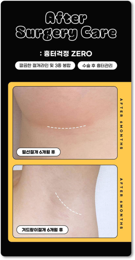Breast Augmentation Surgery Review: Implants, Recovery Time, and How to Minimize Side Effects image 8