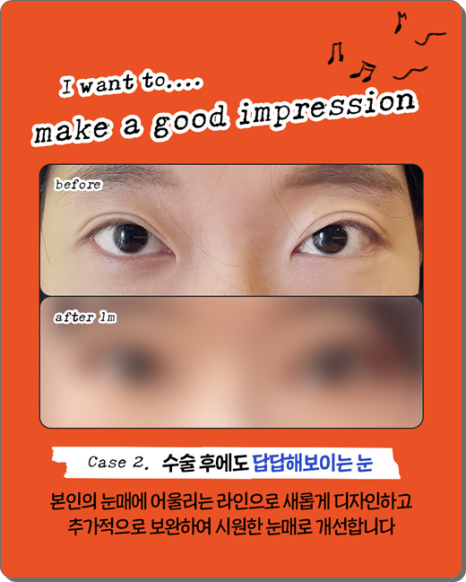 실패 없는 쌍꺼풀 재수술을 위해: 매몰법 특징부터 비용, 시기별 붓기 회복 과정 관련 이미지 12