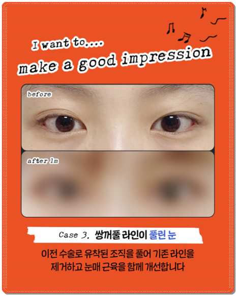 수술 가격이 다른 이유? 매몰과 절개 어떤 쌍꺼풀 재수술을 해야할까? 관련 이미지 12