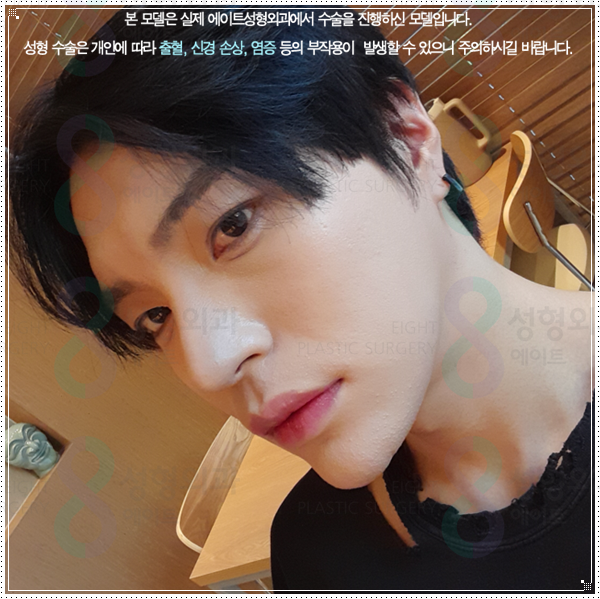 여자와 남자의 코성형 수술 차이점과 비용, 보형물 선택 가이드 관련 이미지 5