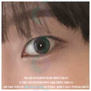 속쌍꺼풀 수술 티안나려면 인라인으로 해야할까? 관련 이미지 3