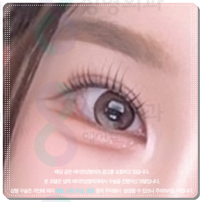 수술 가격이 다른 이유? 매몰과 절개 어떤 쌍꺼풀 재수술을 해야할까? 관련 이미지 4