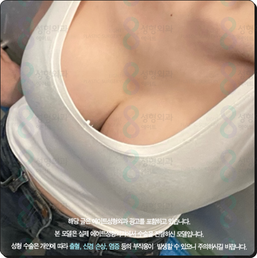 Motiva Breast Augmentation Cost (Price), Before-and-After Reviews: Can the Risk of Surgery Side Effects Be Reduced? image 5