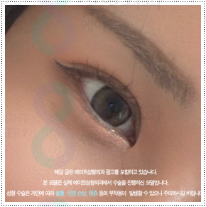 쌍커풀재수술 절개쌍수 말고 매몰은 못하나? 재수술 시 가격 얼마? 관련 이미지 2