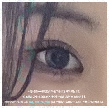 쌍꺼풀 자연유착과 매몰, 절개 사이에서 고민이라면? 비용과 풀림 가능성을 낮추는 수술 방법은? 관련 이미지 4