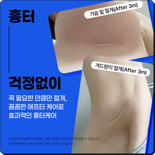 Breast Augmentation Types and Methods, Implant Costs, Pros and Cons image 8