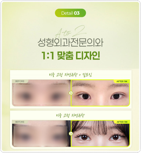 Natural Double Eyelid Surgery Using the Non-Incisional Method: A Budget and Consultation Guide for Middle School Students’ Eye Shapes Before and After Surgery image 14