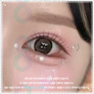 자연유착 쌍꺼풀 수술 후기 | 압구정 쌍수 밑트임 후 붓기 한달 변화 참고 후기 관련 이미지 1