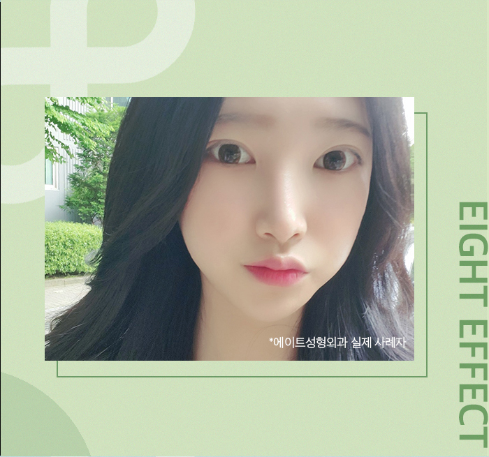 얼굴지방이식붓기 예방하기 위해선? 관련 이미지 6