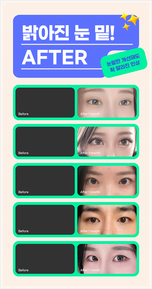 (눈밑지) 20대의 눈밑 지방재배치는 어떻게 진행되나요? 관련 이미지 9