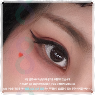 Suture or Incision? Which Double-Eyelid Design Looks Best? Understanding the Differences Between In-Out and In-Line Creases, Including the Semi-Out Line image 3