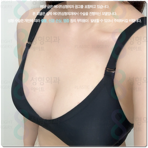 Are You Curious About the Cost of Breast Augmentation Surgery? Understanding the Differences Between Mentor Xtra and Smooth image 2