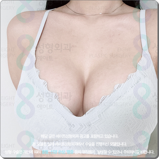 Where Should You Get Motiva Breast Augmentation? Costs and Surgery Tips from a Reputable Clinic image 5