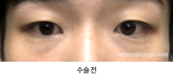 남자눈성형전후 비교해본다면 관련 이미지 1