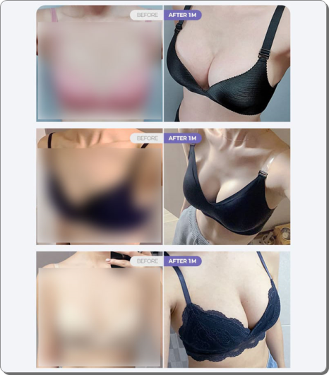 압구정역 가슴수술, 성형외과 추천? 멘토 엑스트라는 비용 전에 가슴 트레이닝센터, 의사를 확인 관련 이미지 11