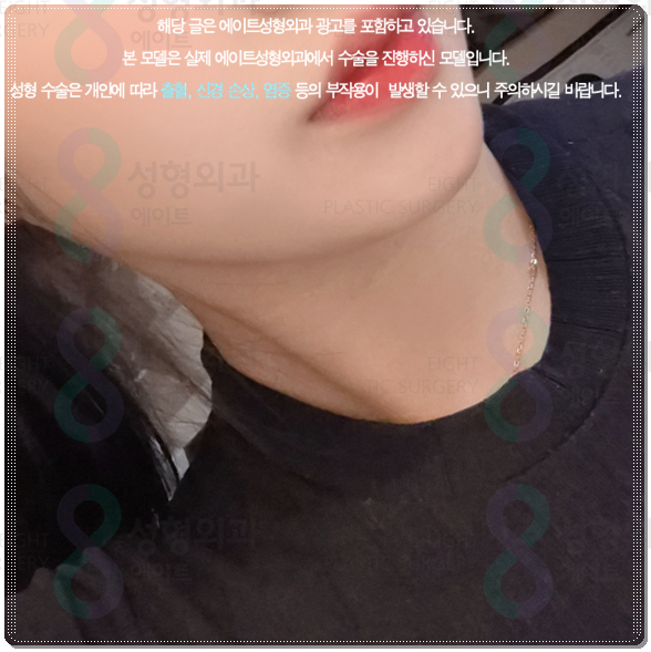 피부과 추천 정보? 울쎄라 강남 어디가 잘하는곳인가요? 수면마취, 가격 부담없이 하는법 관련 이미지 5