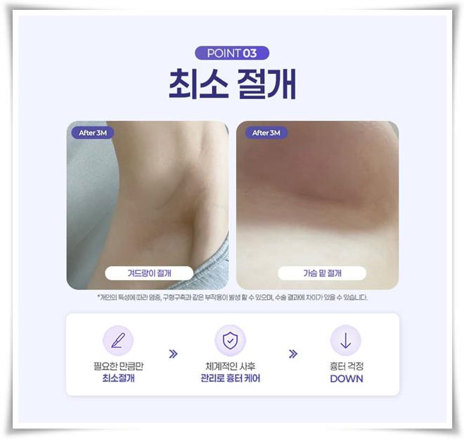 강남 가슴성형, 수술 전 비용보다 부작용을 먼저 봐야 하는 이유 관련 이미지 12