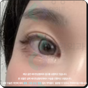 쌍꺼풀수술은 꼭 비절개가 좋을까? 부분절개와 절개의 비용 대비 효과는? 관련 이미지 6