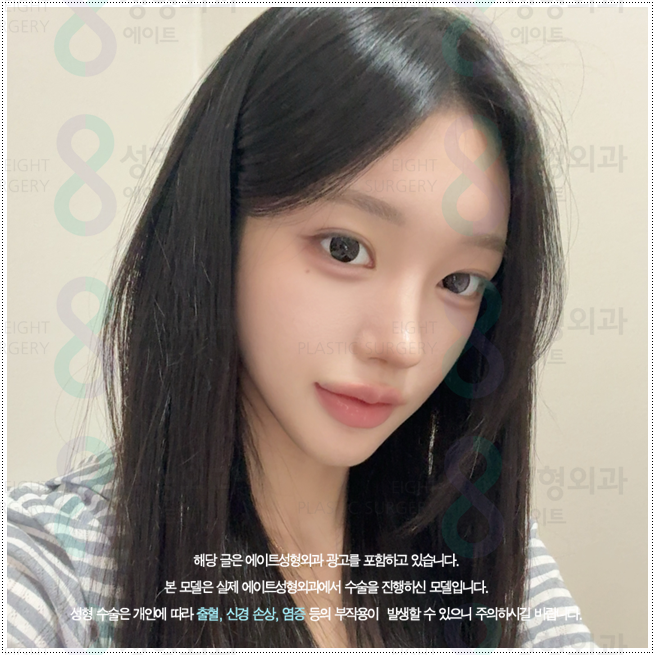 What Types of Rhinoplasty Are Available in Apgujeong? A Look at Bridge and Tip Surgery Prices and Recovery Times image 4