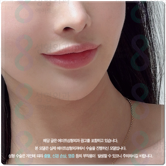 Gangnam) How Much Does 300 Shots of Ultherapy Cost? Treatment Time, Frequency, and Before-and-After Results (Ultherapy PRIME) image 2
