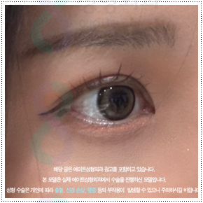 쌍커풀재수술 절개쌍수 말고 매몰은 못하나? 재수술 시 가격 얼마? 관련 이미지 3