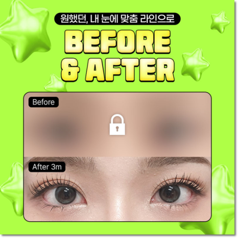 쌍수 가격은 평균적으로 얼마일까요? 매몰과 비절개? 절개 차이점까지 관련 이미지 10
