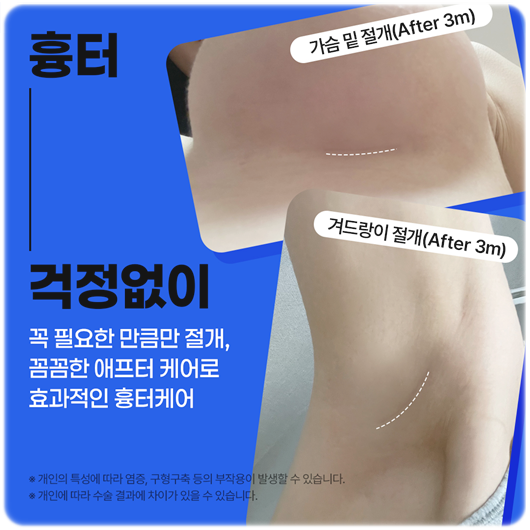 How to Increase Breast Size, Recovery Period for Breast Augmentation with High Satisfaction, Without Worrying About Pain image 8