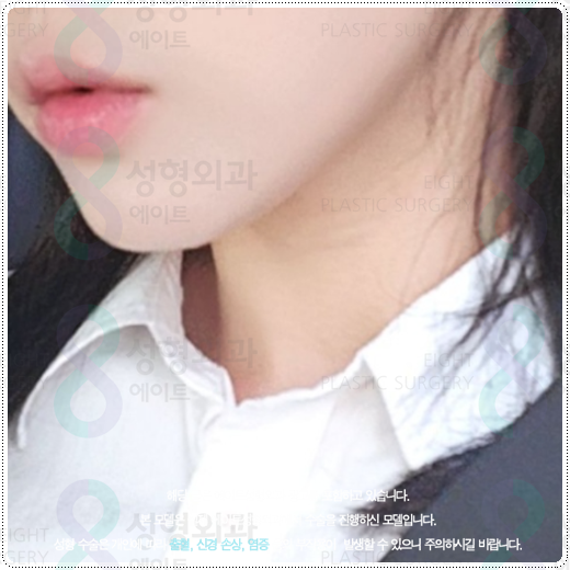 울쎄라 샷 수, 600샷과 300샷 차이점? 부작용 걱정과 가격 부담을 낮추려면 관련 이미지 1