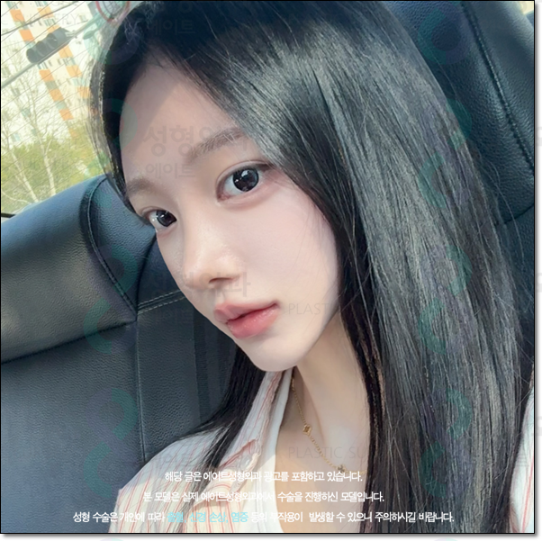 남자와 여자 차이? 매부리코는 수술 가격이 다를까요? 관련 이미지 2