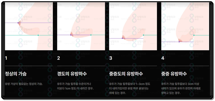 처진 가슴수술 비용 (가격), 후기, 보형물? 거상술? 어떤 방법을 해야하나요? 관련 이미지 6