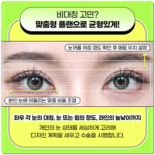 Ptosis Correction Cost: What Are the Criteria for Choosing Non-Incisional or Incisional Surgery? image 8