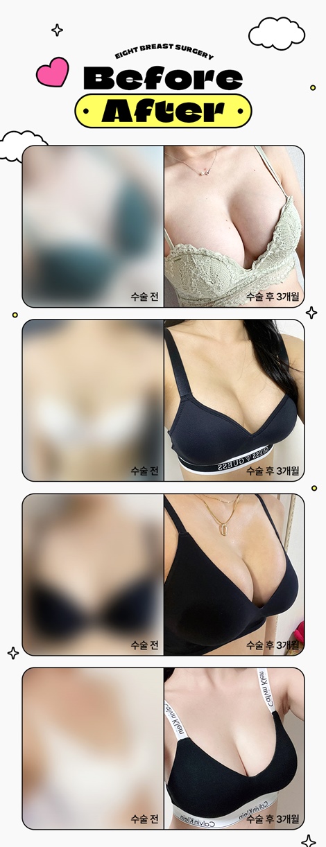 Famous Hospitals for Breast Surgery, Famous Places for Breast Surgery, Apgujeong Breast Surgery Clinic image 12