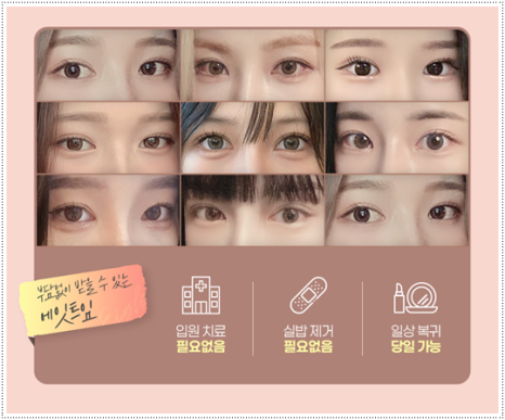 What Are the Prices and Combined Effects of Epicanthoplasty and Upper Epicanthoplasty with Double Eyelid Surgery? From Eye Shape Changes in Reviews of Front-and-Upper Epicanthoplasty to the Differences image 13