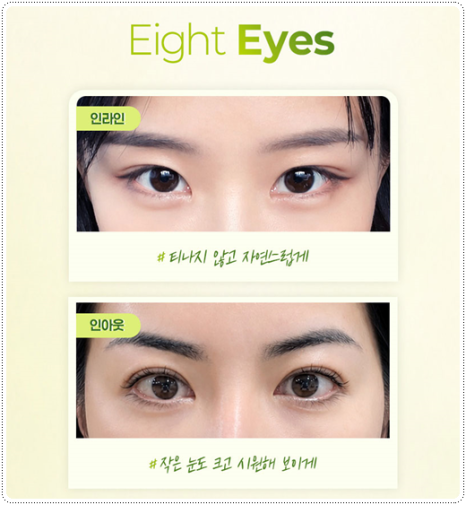 Natural Double Eyelid Surgery Using the Non-Incisional Method: A Budget and Consultation Guide for Middle School Students’ Eye Shapes Before and After Surgery image 9