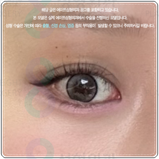 세미아웃라인 쌍수를 매몰로 하는법? 발품 비용 상담 후기 참고용 관련 이미지 5