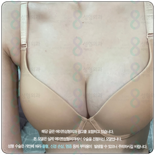 멘토 부스트 가격(비용) 가슴성형 후기 비교 촉감 정말 좋나요? 관련 이미지 1