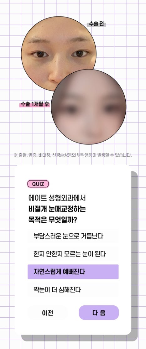 압구정눈매교정 눈매교정잘하는곳 눈매교정유명한병원 안검하수잘하는병원 관련 이미지 7