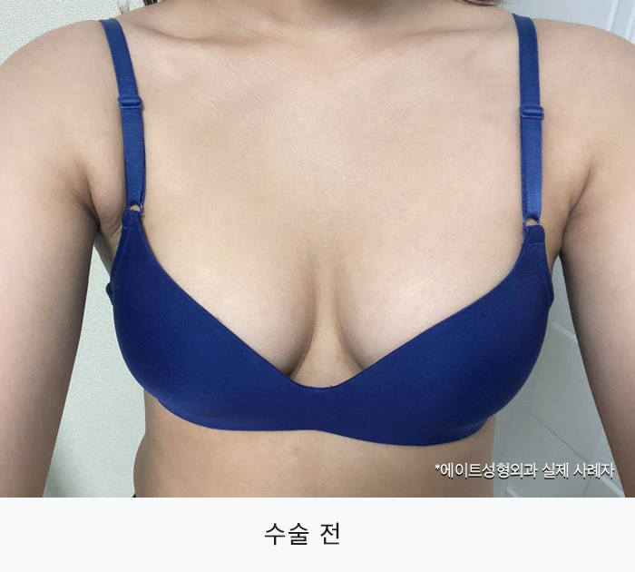 Comparing Before-and-After Feelings Through Breast Augmentation Surgery Reviews image 1