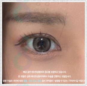 쌍커풀재수술 절개쌍수 말고 매몰은 못하나? 재수술 시 가격 얼마? 관련 이미지 4