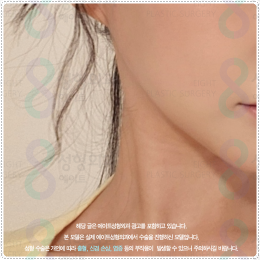 울쎄라 샷 수, 600샷과 300샷 차이점? 부작용 걱정과 가격 부담을 낮추려면 관련 이미지 5