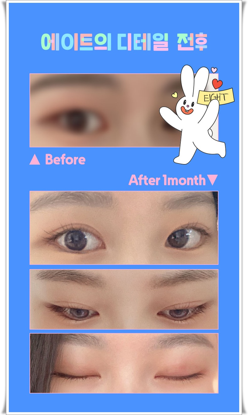자연유착 쌍꺼풀 가격 확인해볼까요? 관련 이미지 4