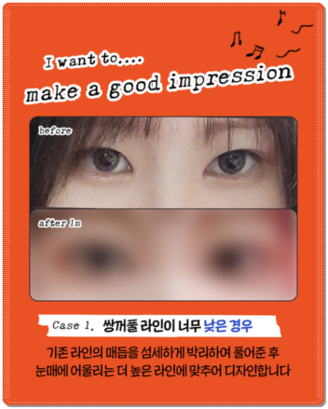 수술 가격이 다른 이유? 매몰과 절개 어떤 쌍꺼풀 재수술을 해야할까? 관련 이미지 10