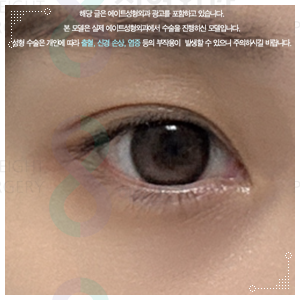 When Can You Wear Makeup After Non-Incisional Double Eyelid Surgery? Including Reviews of Swelling and Loss of the Fold image 2